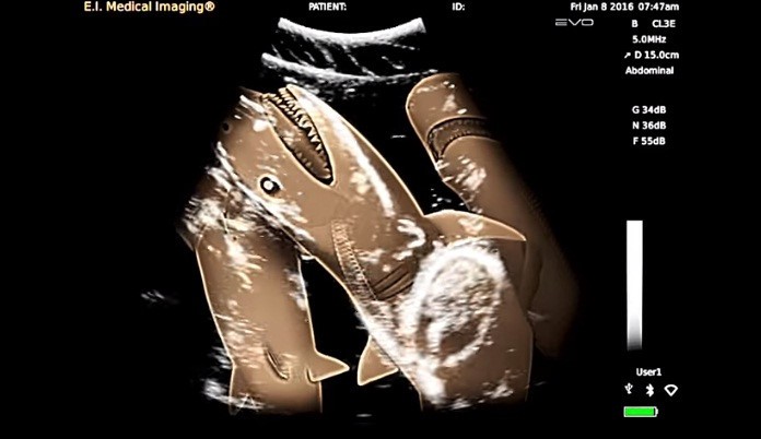 Hình ảnh siêu âm cá mập mang thai. 