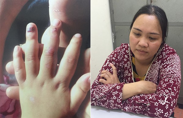 Bà Hải (bìa phải) đã hành hạ con gái người tình; trong đó đánh làm các ngón tay trẻ bầm dập (bìa trái). *ảnh: Nguyệt My