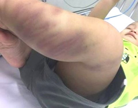 Bé trai hơn 1 tuổi nghi bị bạo hành đang được Bệnh viện Nhi Trung ương điều trị. Ảnh:VNN 