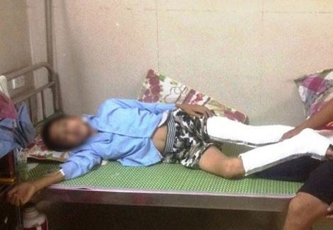 Em Q. đang nằm điều trị tại bệnh viện đa khoa Ninh Bình sau khi nhảy từ tầng 3 xuống đất, bị gãy và vỡ xương chân.