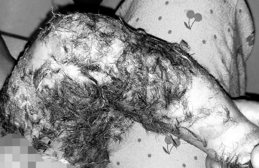 Bé 8 tháng tuổi bị nhiễm trùng vì đắp lông chó chữa bỏng