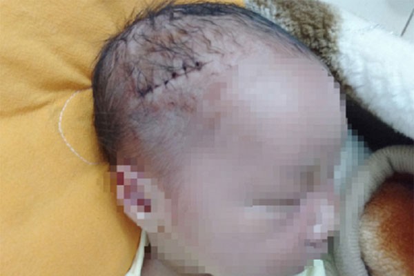 Bé trai mới sinh phải khâu 6 mũi do bác sĩ rạch trúng đầu khi mổ