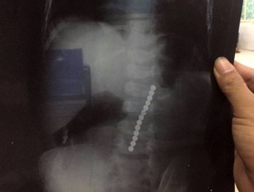 Kết quả chụp X – Quang cho thấy, 13 viên bi trong dạ dày cháu Sang. 