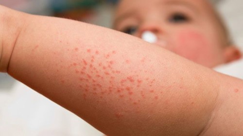 Những phương pháp bảo vệ bạn và gia đình khỏi bị sốt xuất huyết