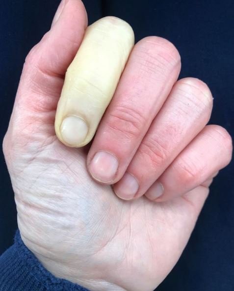 Hình ảnh ngón tay trắng bệch do bệnh Raynaud. Ảnh: Jenni Falconer. 