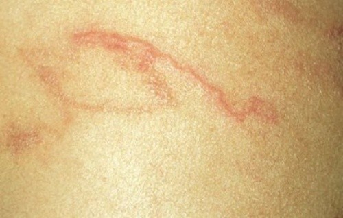 Những nốt sẩn ngoằn ngoèo dưới da ở bệnh nhân nhiễm giun lươn mạn. Ảnh: T.H. 