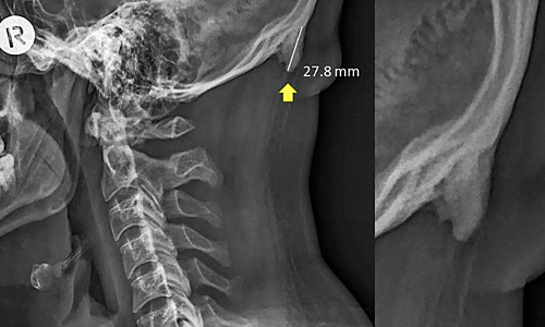 Ảnh chụp chiếc gai đằng sau cổ của một nam bệnh nhân 28 tuổi. Ảnh: David Shahar/Mark G L Sayers/Scientific Reports/CC. 