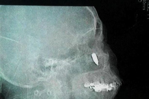 Ảnh chụp X-quang cho thấy viên đạn nằm sát sống mũi bệnh nhân.