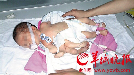 Em bé tám chân tay ở Trung Quốc
