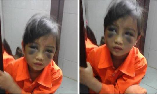 Hình ảnh em bé bị cô giáo bạo hành được đăng tải trên nhiều trang mạng mấy ngày nay.
