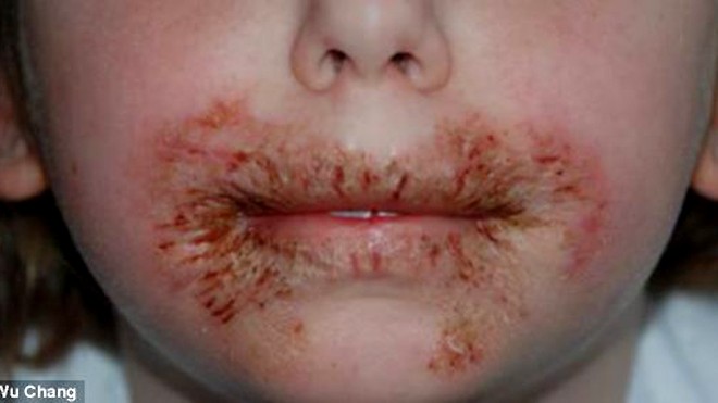 Một bé gái bị mẩn rát vùng miệng vì dị ứng chất bảo quản MI trong giấy ướt