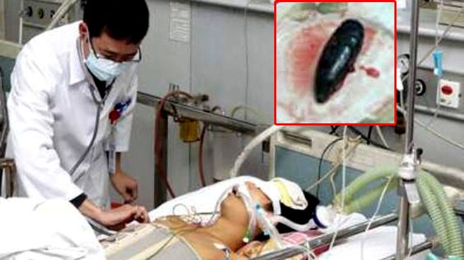 Bệnh nhân bị ngộ độc mật cá trắm (ảnh lớn) và mật cá trắm (ảnh nhỏ)