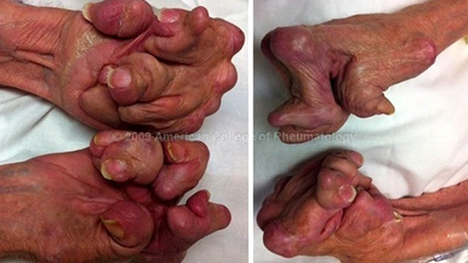 Đôi bàn tay bị biến dạng do không điều trị bệnh viêm khớp dạng thấp huyết thanh dương tính