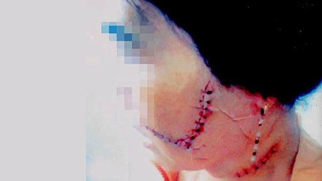 Bà LTT với các thương tích trên mặt do bị rạch bằng dao lam. Ảnh: Tấn Lộc