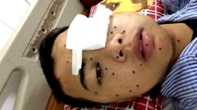Cháu Trần Mạnh Cường bị 50 viên đạn chì bắn vào mặt , vào đầu
