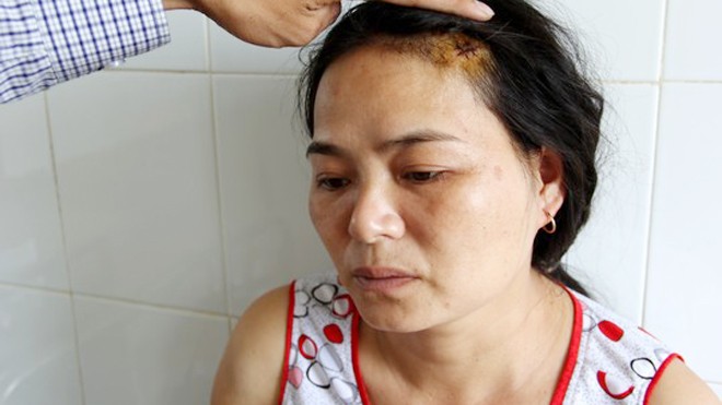 Chị Nguyễn Thị Thúy tố cáo bị chồng hành hung khiến thương tích khắp người