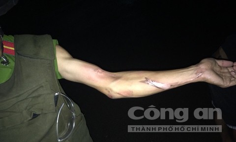 Cánh tay trái của một chiến sĩ công an bị bỏng trong lúc khống chế Dương