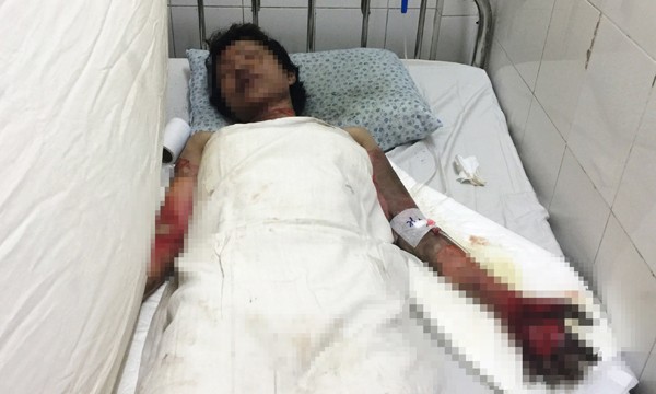 Nạn nhân và cũng là thủ phạm Nguyễn Thị Hồng đang điều trị tại BVĐK Khu vực Thủ Đức trong tình trạng bỏng nặng