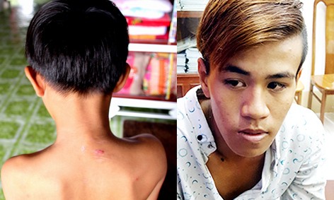 Vết thương sau lưng cậu bé vẫn còn để lại sẹo dù đã gần chục ngày xảy ra sự việc và đối tượng Dương Văn Toàn tại cơ quan công an
