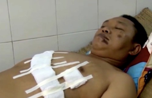 Sơn bị thương ở phần bụng và ngực đang được điều trị tại bệnh viện đa khoa thị xã Sơn Tây