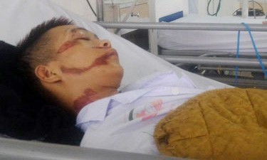 Em Huy toàn bộ khuôn mặt bị biến dạng, vỡ hộp sọ và chấn thương sọ não, hiện đang nằm cấp cứu tại bệnh viện Quân y 4