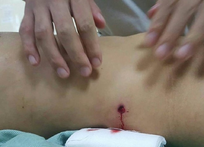 Viên đạn xuyên thủng vùng bụng của nạn nhân