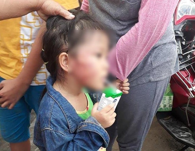 Bé Chi (5 tuổi) với thương tích trên mặt nghi bị cô giáo bạo hành. Ảnh: Người nhà cung cấp