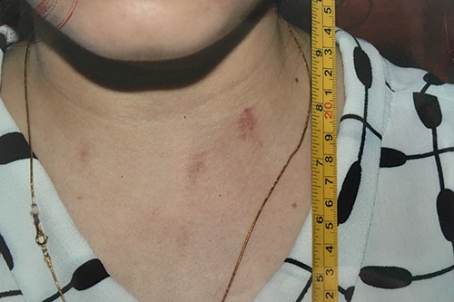 Các vết xước trên cổ nữ nạn nhân được ghi nhận sau khi vùng chạy ra khỏi phòng