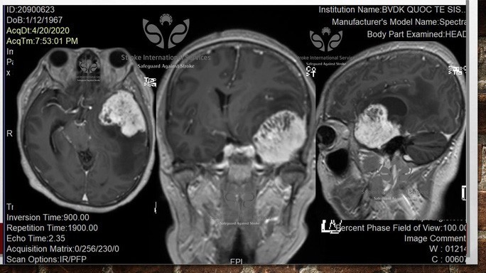 Khối u não khổng lồ của bệnh nhân vừa được SIS phát hiện và cứu nguy