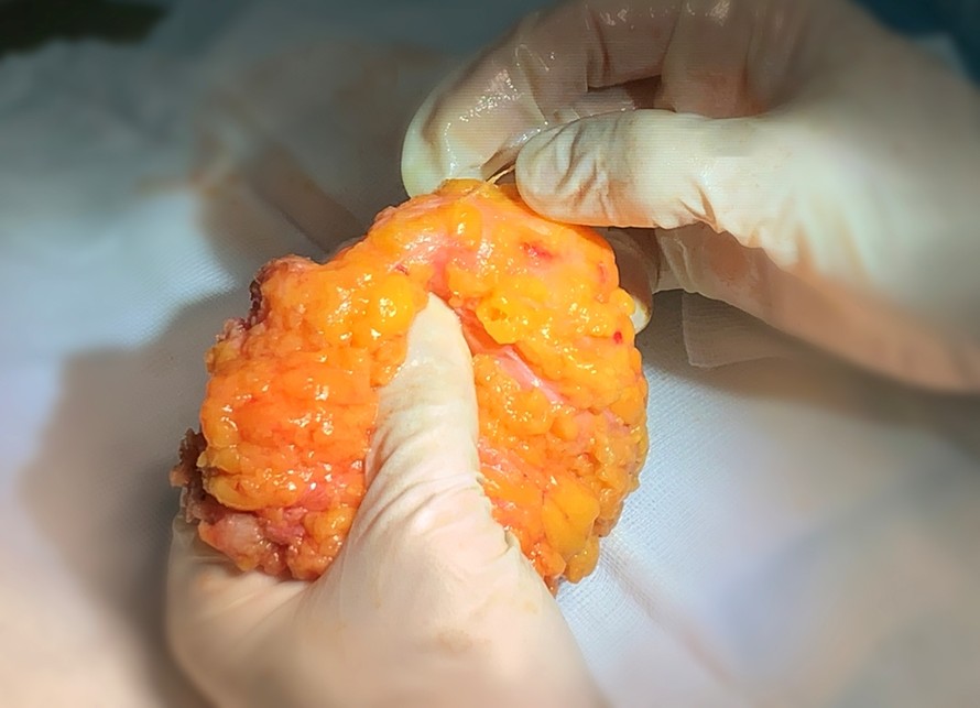 Khối silicon trong ngực được lấy ra sau phẫu thuật