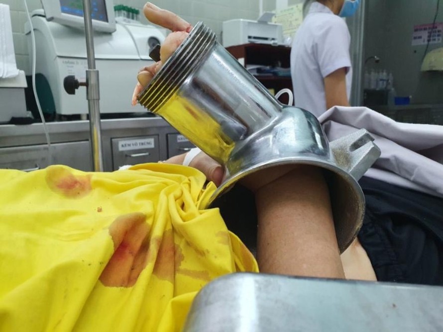 Bệnh nhân bị máy xay thịt nghiền nát bàn tay (ảnh: BVCC)