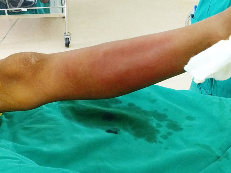 Bé gái suýt mất chân vì gia đình tự ý chữa bằng cắt lễ dân gian