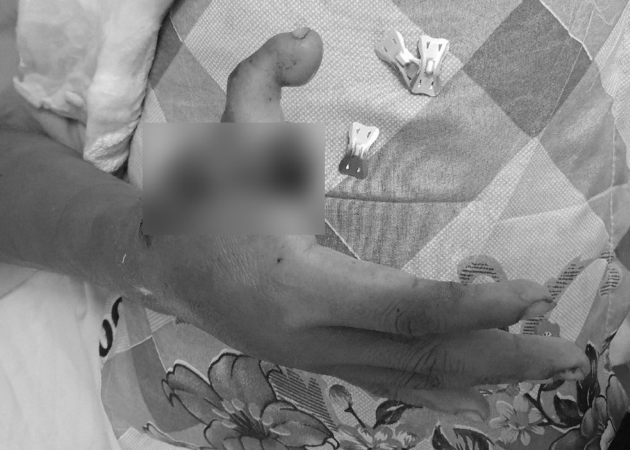 Phẫu thuật ‘dời’ ngón chân lên làm ngón tay cái cho nam bệnh nhân