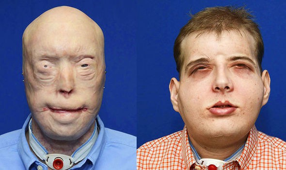 Trước và sau khi phẫu thuật 