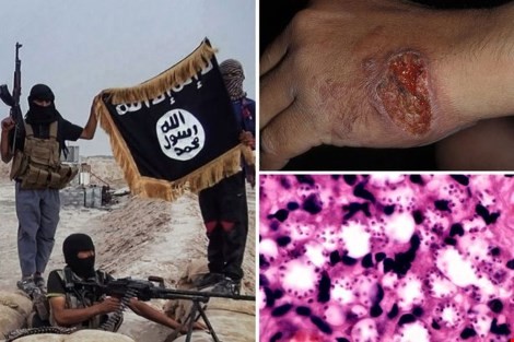 Cận cảnh những vết lở loét của binh lính IS. Ảnh: The Sun 