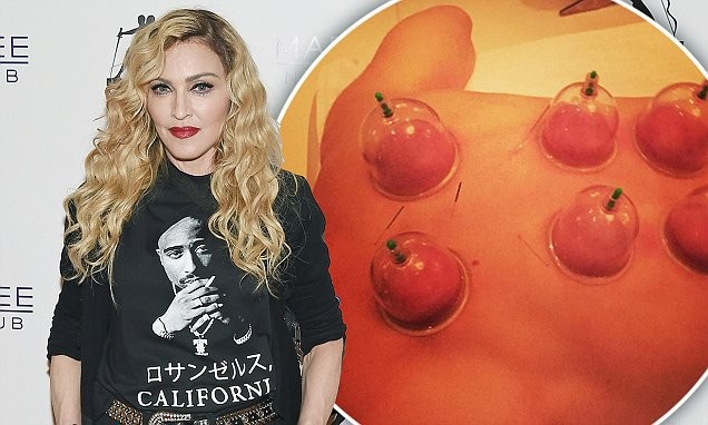 Madonna tiết lộ sở thích 'cạo gió, giác hơi' xả stress