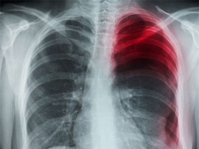 Hình ảnh X-quang chụp phổi anh Ou
