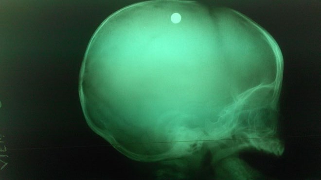 Viên đạn trong đầu bé trai 6 tuổi qua chụp X-quang- ảnh BV nhi đồng 2. 