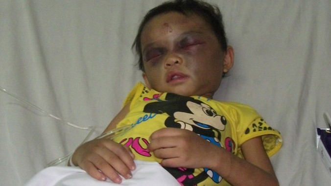 Bé gái 4 tuổi bị bố đẻ hành hung phải nhập viện 