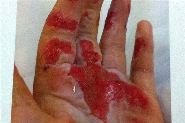 Tổn thương bỏng lòng bàn tay do đá khô. Ảnh: abc.net.au