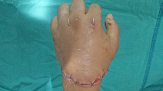 Bàn tay của Võ Ngọc Anh đã được Bệnh viện chấn thương chỉnh hình Nghệ An nối lại.