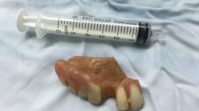 Hàm răng giả được các bác sỹ gắp ra khỏi thực quản ông Ng