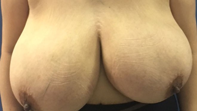 Chị Hạnh với bộ ngực khổng lồ trước khi phẫu thuật