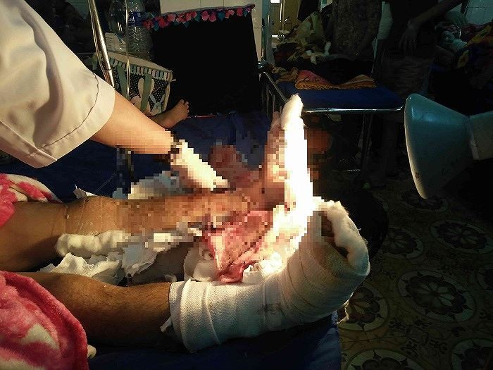 Hai cẳng chân của nạn nhân được các bác sĩ phẫu thuật ghép nối thành công