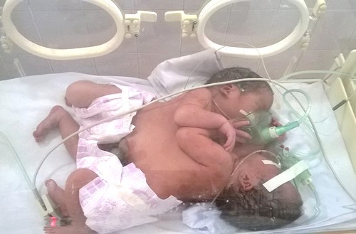 Cặp song sinh dính nhau đang được chăm sóc đặc biệt tại khoa Hồi sức Bệnh viện Việt Đức. Ảnh hai bé lúc mới chào đời do bệnh viện cung cấp. 