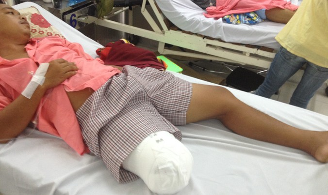 Bệnh nhân Lê Hoàng Lâm sau khi bị cắt cụt chân.