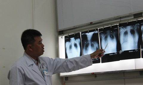 Bác sĩ Trần Thanh Linh cho biết phim chụp cho thấy tim bệnh nhân có bóng phình to