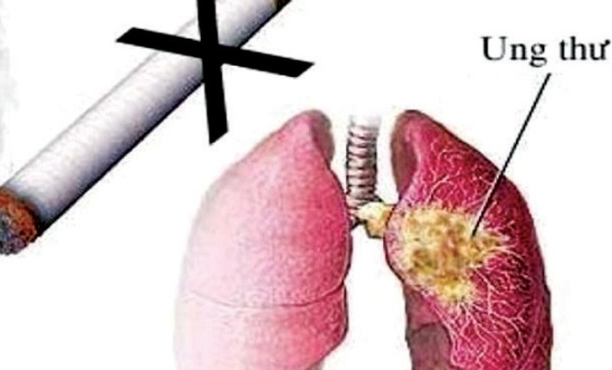 Hút thuốc lá là nguyên nhân của 90% các ca ung thư phổi.