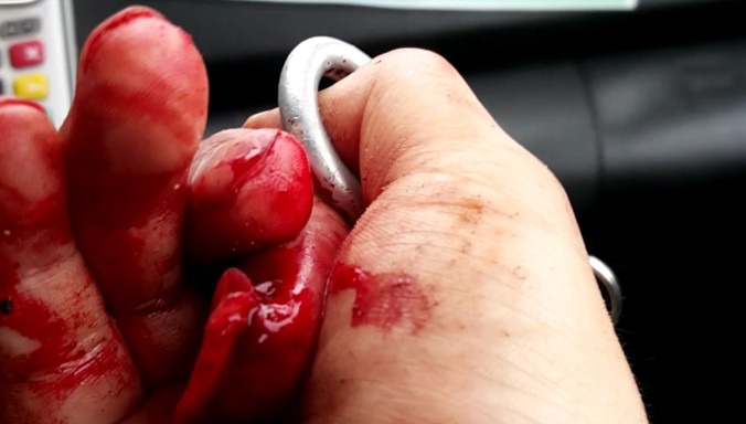 Ngón tay trỏ phải của nhà báo Đỗ Doãn Hoàng bị thương tích nặng. Ảnh: Nhân vật cung cấp