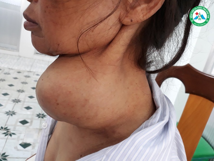 Bà Y V. với khối u đeo nặng trên cổ trước khi mổ